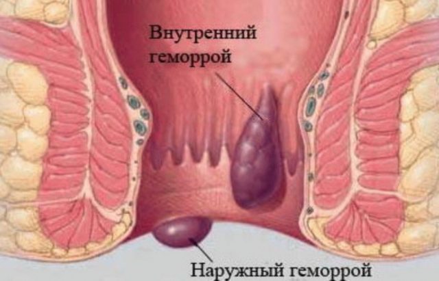 Обострение геморроя - причины, симптомы, лечение, диета и стадии, что делать?