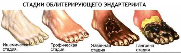 Болезни сосудов ног: причины появления и методы лечения