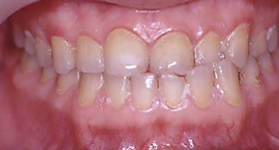 Острый, язвенно-некротический гингивит Венсана: лечение, симптомы и диагностика