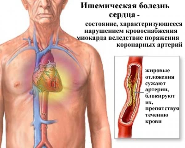 Покалывание в верхней части грудной клетки