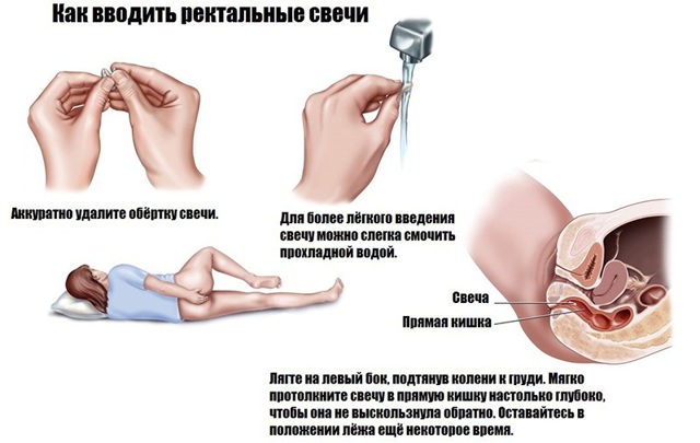 Кровоостанавливающие свечи от геморроя недорогие и эффективные — Давление и всё о нём