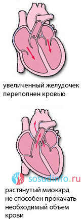 Систолическая жесткость сосудов и миокарда. Дисфункция предсердий и перегрузка объемом