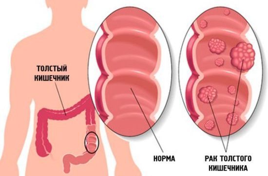Кровотечение из заднего прохода без боли при стуле: причины и лечение