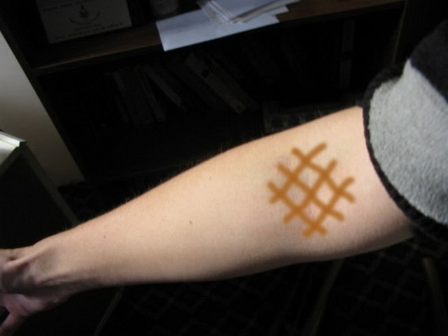 Флебит вены на руке. Лечение постинъекционного флебита после катетера