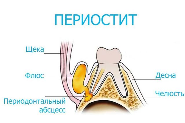 Периостит зуба: виды, причины, симптомы и лечение