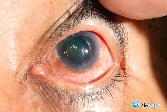 При сахарном диабете упало зрение что делать — Диабет и всё о нём