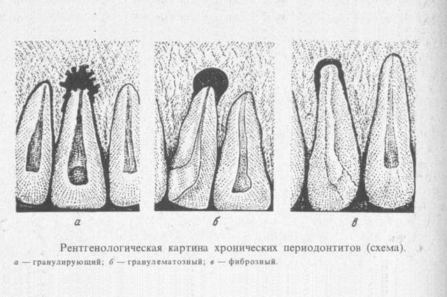 Хронический периодонтит - причины, симптомы, диагностика и лечение