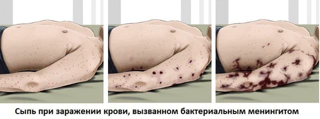 Менингит — симптомы, лечение и последствия