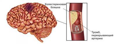 Нестенозирующий атеросклероз артерий