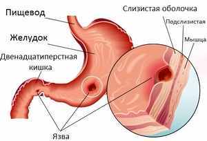 Кровь в желудке: причины и симптомы, диагностика и лечение