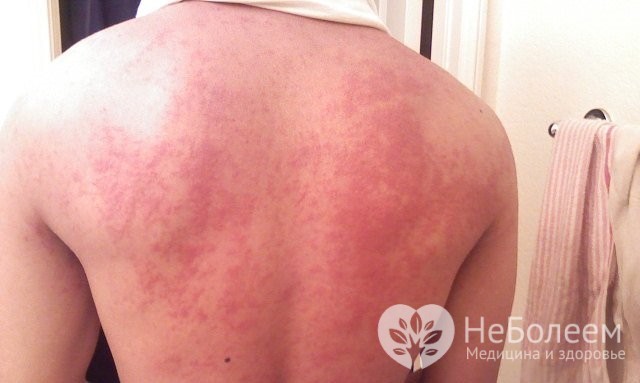Вирус Зика - причины, симптомы и лечение Zika virus