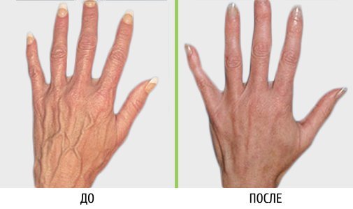 Очень видно вены на руках - Сайт о варикозе