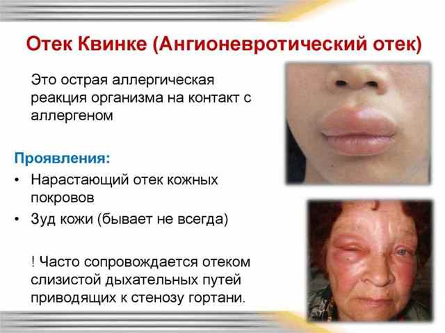 Отек Квинке симптомы и лечение в домашних условиях народными средствами