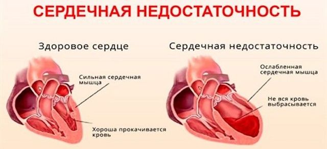 Гипертоническая болезнь — Викиучебник
