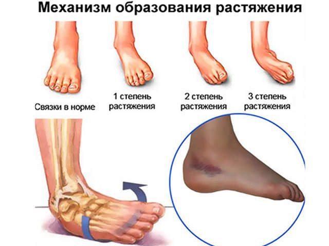 Носок эластичный медицинский для голеностопа - лекарства, медикаменты, препараты, свечи