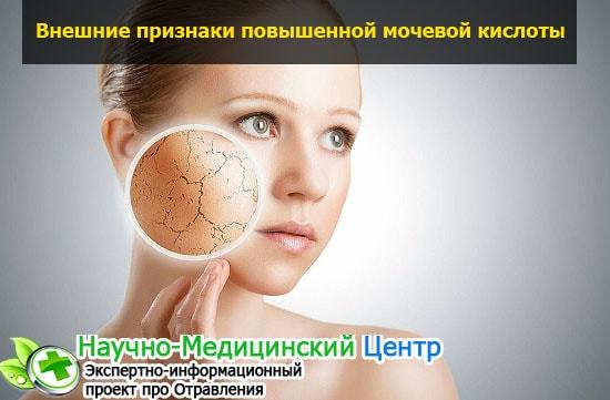Мочевая кислота составляет уменя 755 что делать. Какая норма мочевой кислоты в крови мужчин, женщин и детей