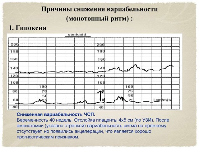 КТГ при беременности: расшифровка и норма, сроки и что показывает по неделям - видео