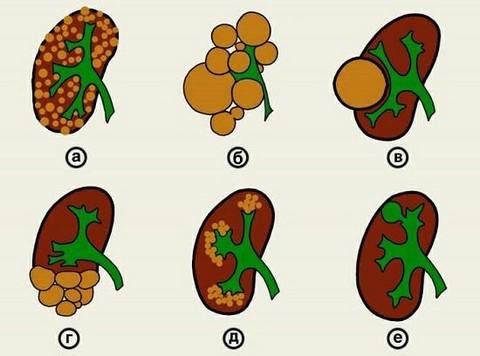 Киста почки - причины, признаки, симптомы и лечение