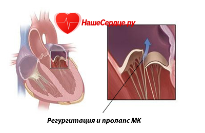 Сердечный клапан не закрывается до конца