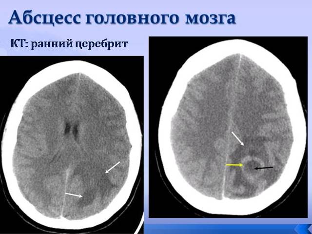 Абсцесс головного мозга - симптомы, лечение, причины, прогноз