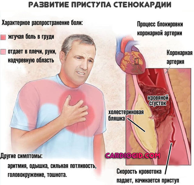 Предынфарктное состояние: что это такое, что делать, признаки, симптомы и лечение