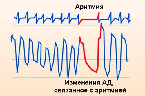 Аритмия сердца: симптомы, лечение