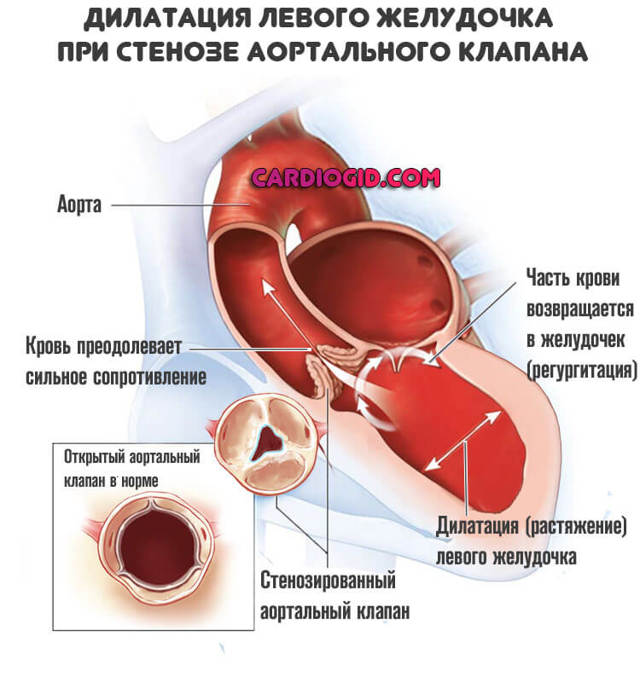 Стеноз аорты: симптомы и медикаментозное лечение