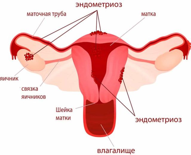 Месячные после выскабливания когда пойдут: после чистки матки, абортивного выскабливания, обильные, первые