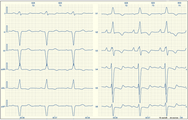 Нагрузка на левое предсердие - Все про гипертонию