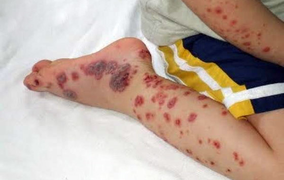 Идиопатическая тромбоцитопеническая пурпура.