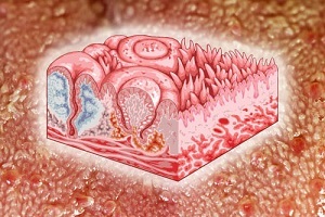 Желтый налет на языке у ребенка