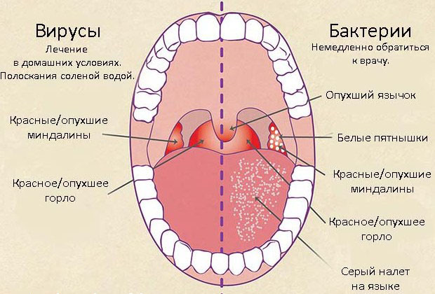 Фарингит – острый и хронический. Симптомы и лечение фарингита.