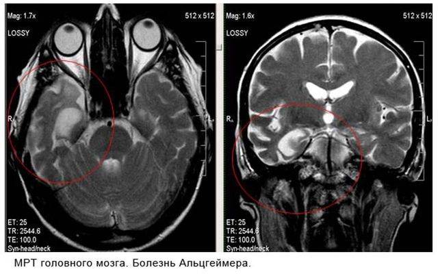 Единичные очаги в белом веществе головного мозга - результаты МРТ