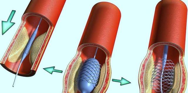 Предынфарктное состояние у женщин и мужчин: признаки, как вовремя распознать и начать лечение