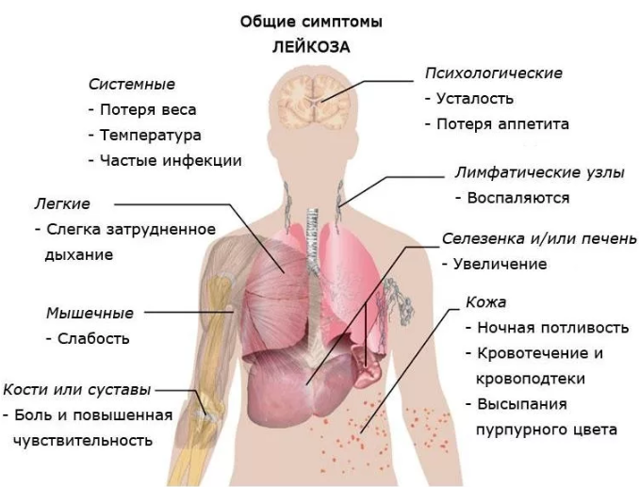 Острый миелобластный лейкоз прогноз жизни у взрослых