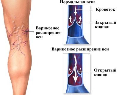 Отеки ног при сердечной недостаточности