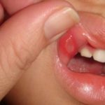 Афтозный стоматит у детей и взрослых: фото, лечение