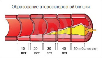Гипоплазия левой позвоночной артерии: что это такое, лечение и симптомы