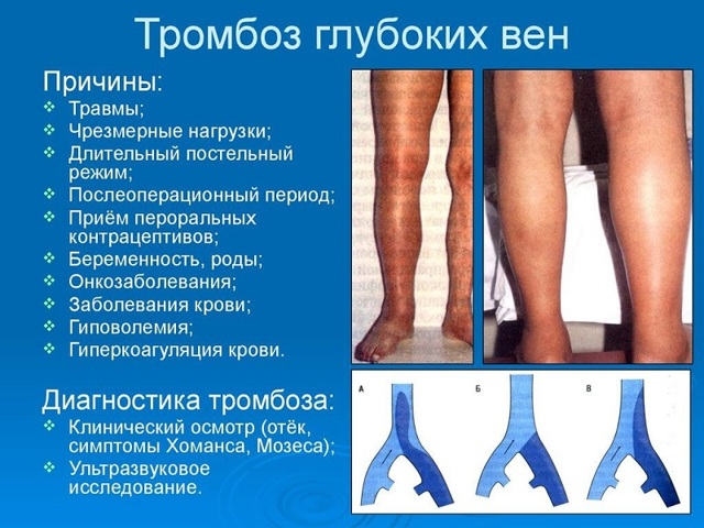 Боли в ногах при сахарном диабете - Здоровье людей
