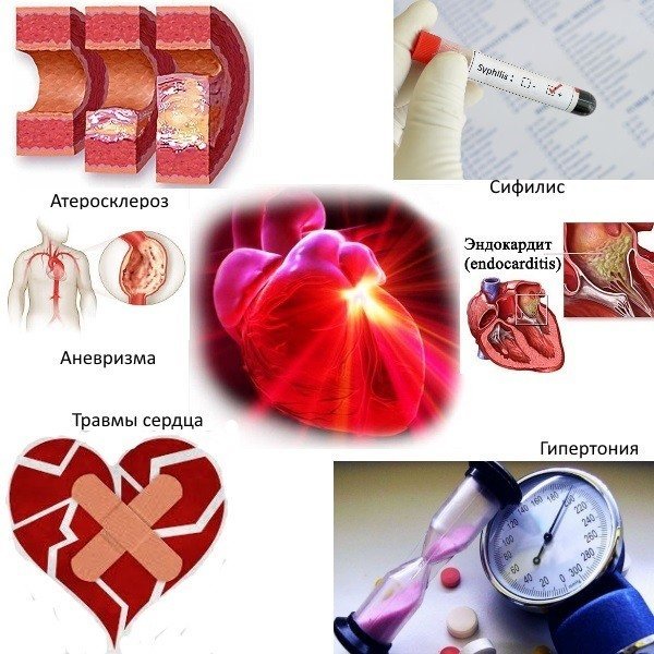 Аортальный порок сердца: симптомы и лечение