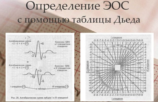Отклонение эос влево что это такое — Сердце