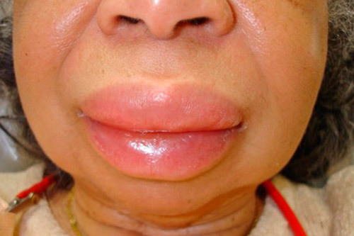 Лечение гипертонии йодом (по индийскому методу)