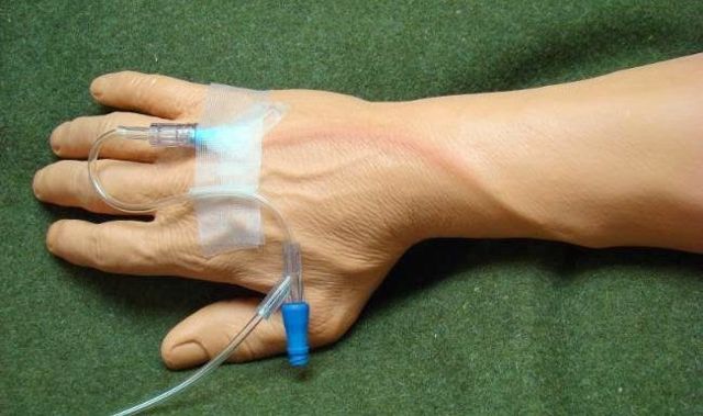 Флебит вены на руке. Лечение постинъекционного флебита после катетера