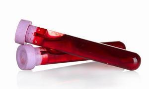 Лимфоциты повышены у взрослого, о чем это говорит? Причины повышенных лимфоцитов у взрослых