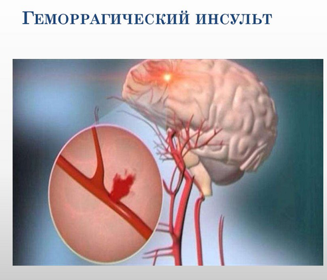 Инвалидность после инсульта