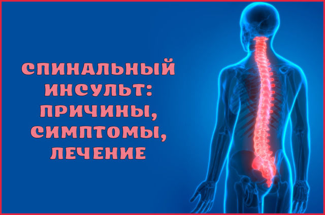 Инсульт спинного мозга (спинальный): симптомы, лечение, последствия