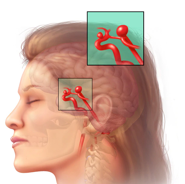 Спазмы сосудов головного мозга: симптомы, лечение, препараты, профилактика