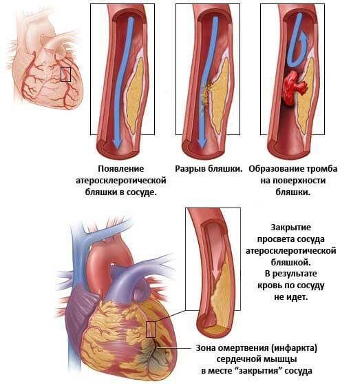 Давление 140 на 100: нужно ли сбивать и в каких случаях опасно