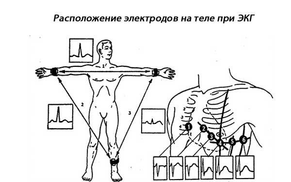 Инфаркт миокарда на ЭКГ: признаки, расшифровка