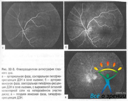 Передняя ишемическая нейропатия